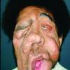 Malformation humaine et maladie rare