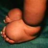 Malformation humaine et maladie rare