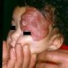 Malformation humaine et maladie rare