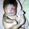 Malformation humaine et maladie rare