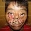Malformation humaine et maladie rare