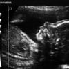 Echographie foetus