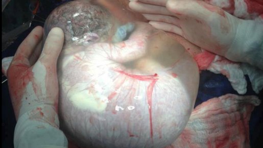 un-bebe-dans-sa-poche-des-eaux.jpg